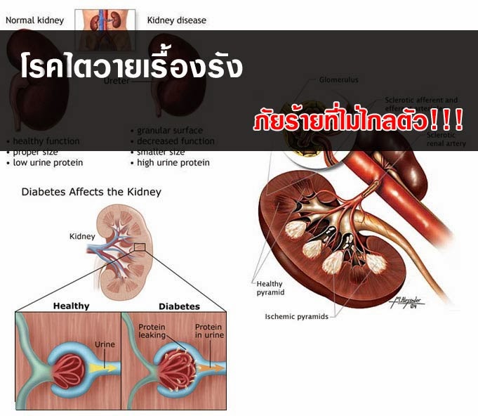 Diabetic Nephropathy